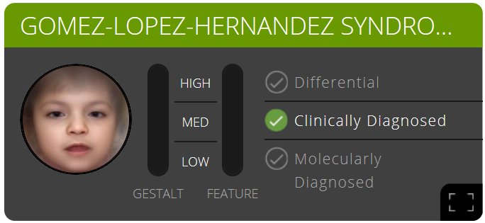 Pedia_Team's tweet photo. Introducing the second disease with unknown molecular cause for #PEDIA2: Gomez-Lopez-Hernandez syndrome.
See you @fdna-workshop! #eshg2017 https://t.co/7zyXoANrOj