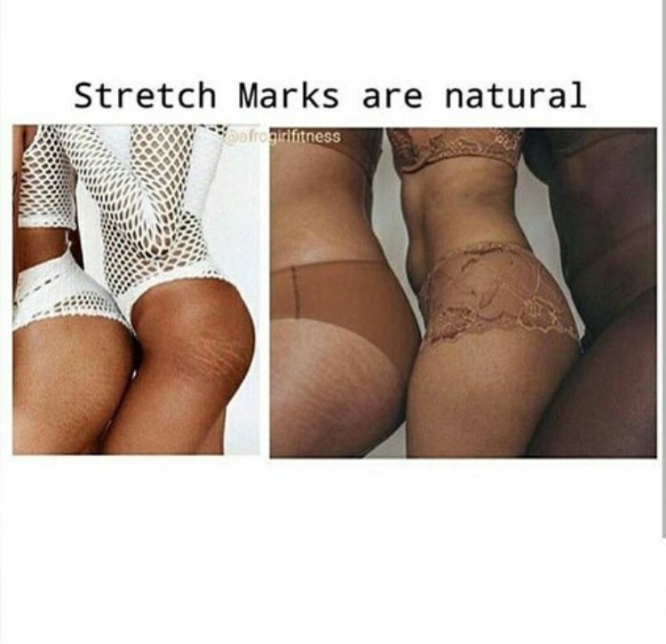 BoPoMemes's tweet image. Your reminder that stretch marks are human. Bodies are meant to grow. #bodypositivememes