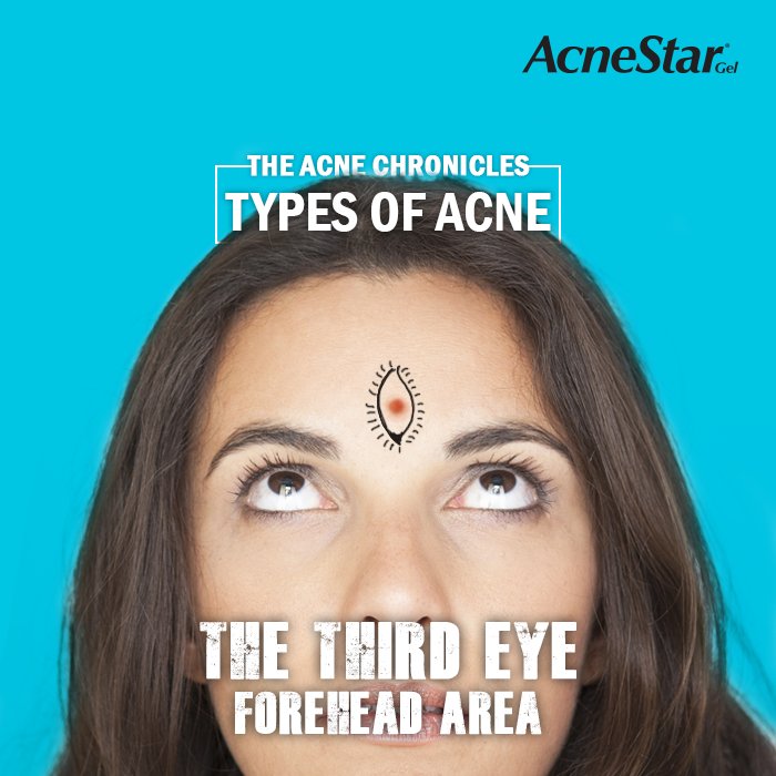 AcnestarGel's tweet photo. Acne Chronicles #3
Drink loads of water and stay hydrated to avoid the ‘third’ eye.
#acnechronicles #typesofacne #skincare #acnetips https://t.co/O32U1xHeNI