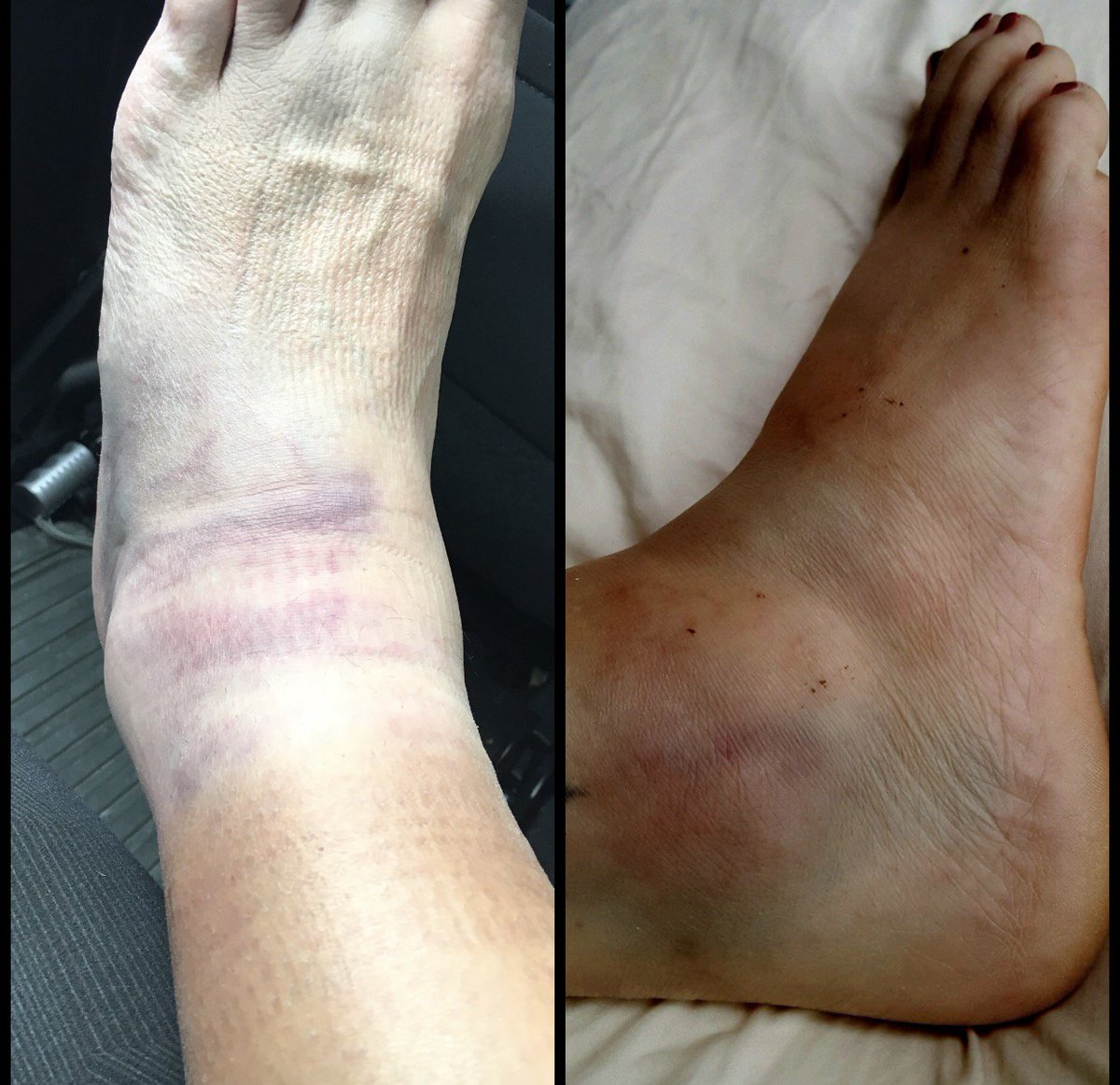 Tommy Dreamer on X: Who wore their newly broken ankle better @nunzio_guido  or Beulah McGillicutty They are Hardcore t.cokoXUld6eWC  X