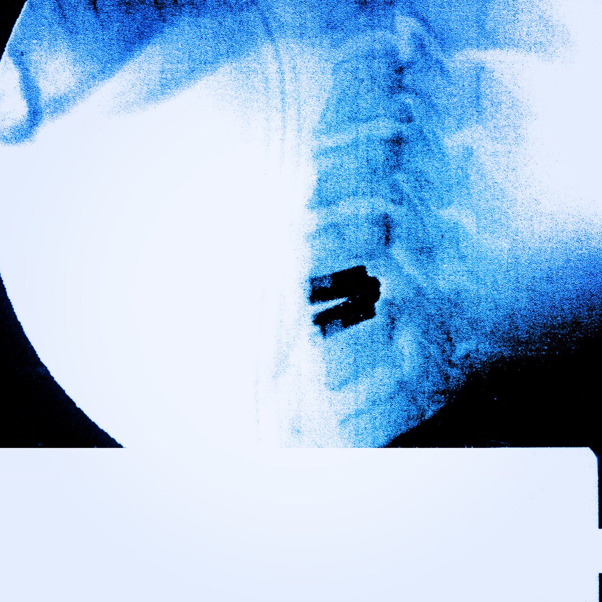 #xray of my neck. I became #ironman too today.. from #Xmen 
俺の首の #レントゲン。 今日 #アイアンマン にもなった。 #Xメン から
instagram.com/p/BULndRlgRPM/…