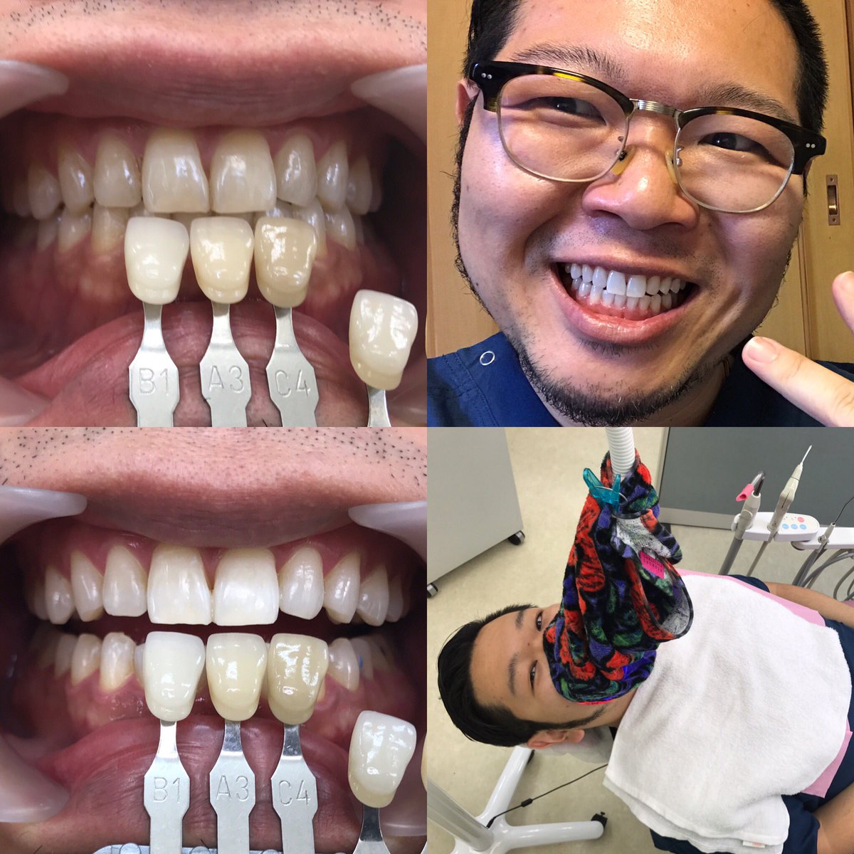 Dr Coyass Frome P O 診療の空き時間で 人体実験したい事があったので スーパーポリリンホワイトニングしてみました コーヒーとか茶渋がいい感じについて 濃い色になってたのてますがa3からb1まで一回で白くしました ここで知覚過敏症状が出るので