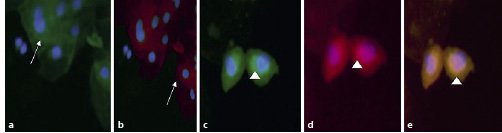 nephron_journal's tweet photo. In #IgA #Nephropathy, #Glomerulosclerosis Is Associated with #CD80 Excretion and uPAR #Podocyturia https://t.co/6KC4FyYNTS @Htal_Britanico https://t.co/TjQFKeCx7f