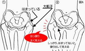 み 足の付け根にある大転子が出てるせいで太く短く見えるし痩せにくいから今日から大転子を引っ込めるストレッチはじめる 脚やせは難しいから骨盤の歪みをとって老廃物を流しやすい痩せやすい身体に改善していく