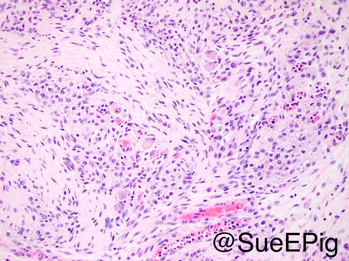 SueEPig's tweet photo. Incidental pancreatic gangliocytic paraganglioma adjacent to mucinous cystic tumor of pancreas #hartfordpath #gipath #pancreas #pathology https://t.co/osT13CZRlx