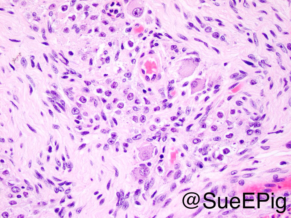 SueEPig's tweet photo. Incidental pancreatic gangliocytic paraganglioma adjacent to mucinous cystic tumor of pancreas #hartfordpath #gipath #pancreas #pathology https://t.co/osT13CZRlx