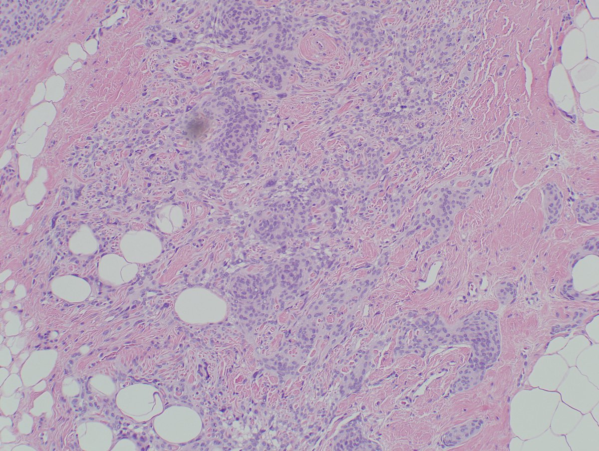 dmlarsonpath1's tweet photo. @LilDocLiz1 @mlage @marenwhymd @JaniceWilsonMD This was deep in the fat with overlying normal skin and subcutaneous tissue. https://t.co/72Rbkkrxe5