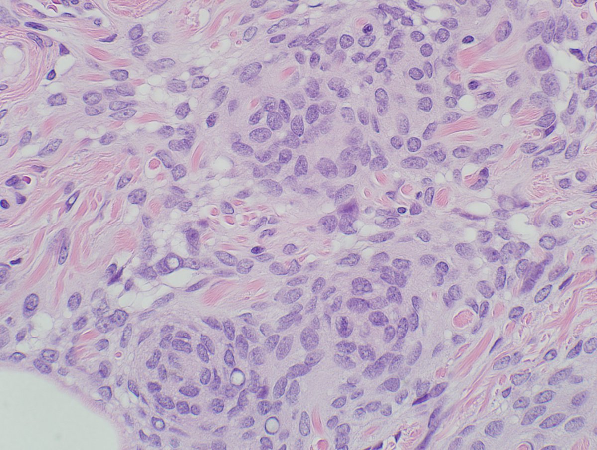 dmlarsonpath1's tweet photo. @LilDocLiz1 @mlage @marenwhymd @JaniceWilsonMD This was deep in the fat with overlying normal skin and subcutaneous tissue. https://t.co/72Rbkkrxe5