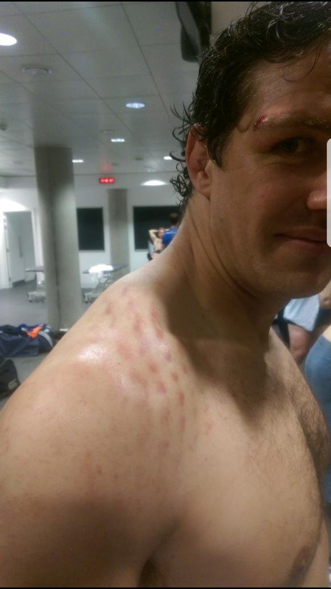 MikeRoss03's tweet image. Throwback to @mikemccarthy6 hitting lads so hard that his shoulderpads left an imprint on his skin! Warrior. You'll be missed. 
#thanksdad