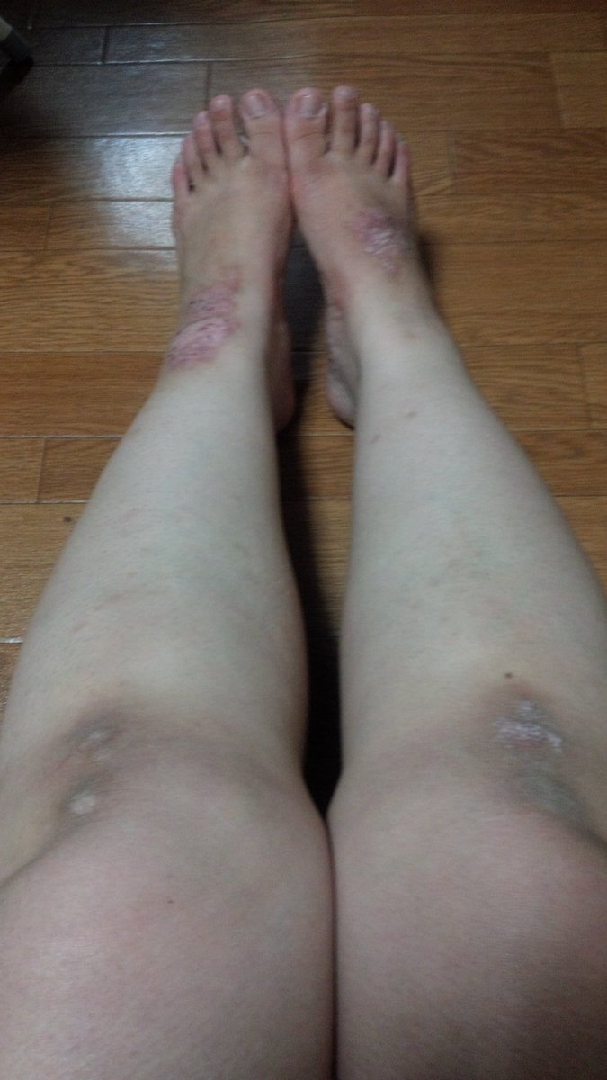 monmon20080224's tweet photo. 乾癬性関節炎の治療中でステラーラを3回打ったが効果があまりみられなかったので今日の朝からオテズラ錠を始めます。
#乾癬
#乾癬性関節炎
#ステラーラ
#オテズラ錠 https://t.co/N1HPfq0IQZ