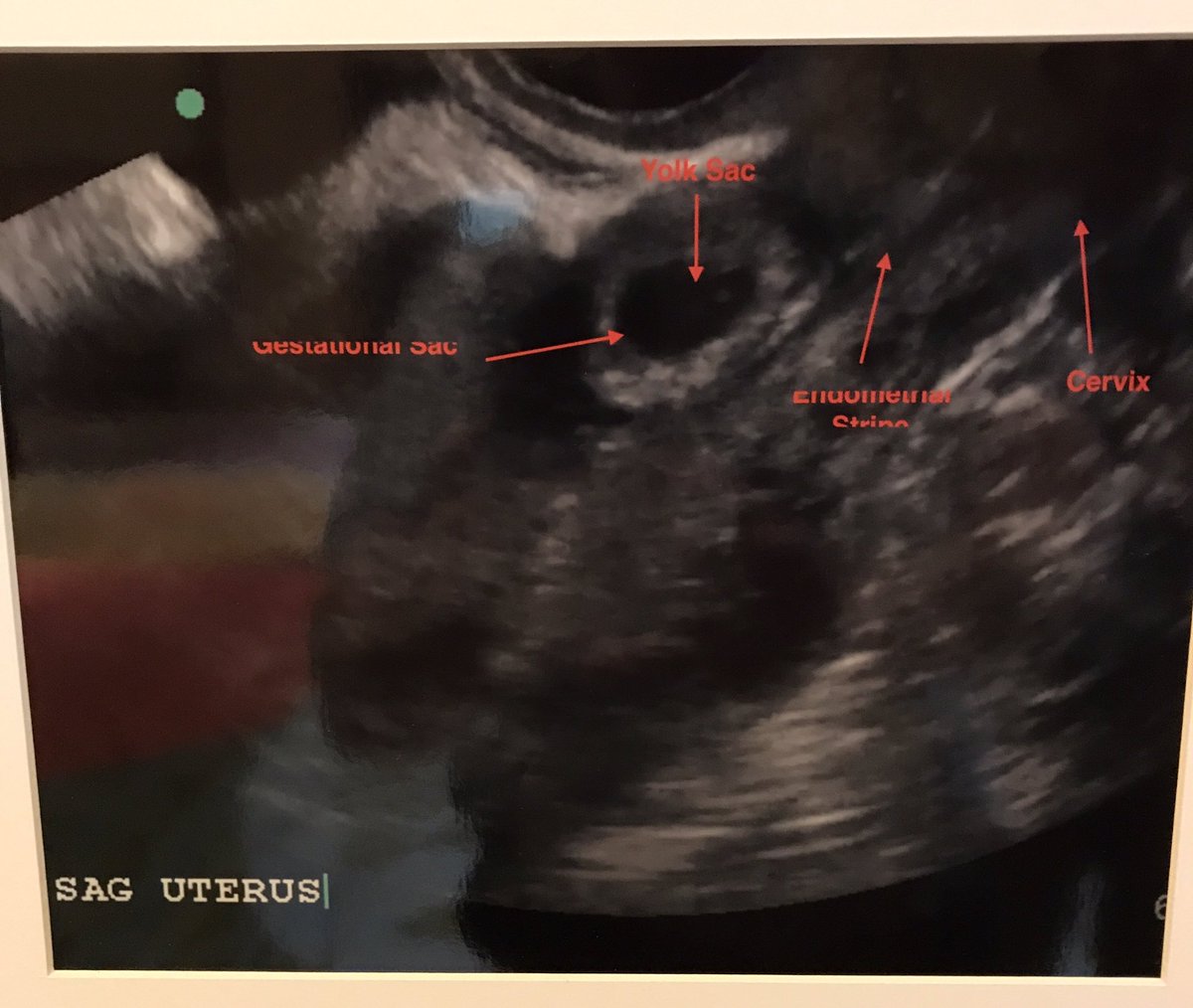 TemplePOCUS's tweet photo. @Zamboni_MD @markamagee #SAEM17 photo contest #scartopic @TempleEM https://t.co/zk04tzTu9G