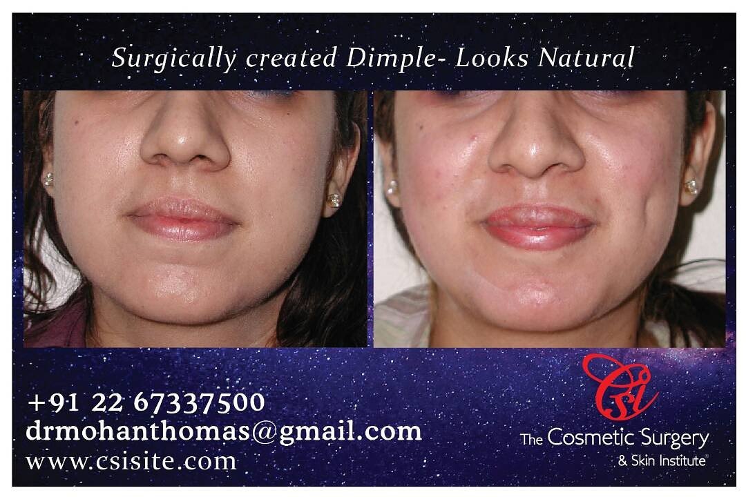 DIMPLE CREATION #dimplecreation#safe               #surgicalprocedure#CosmeticSurgeryInstitute
Mumbai India csisite.com