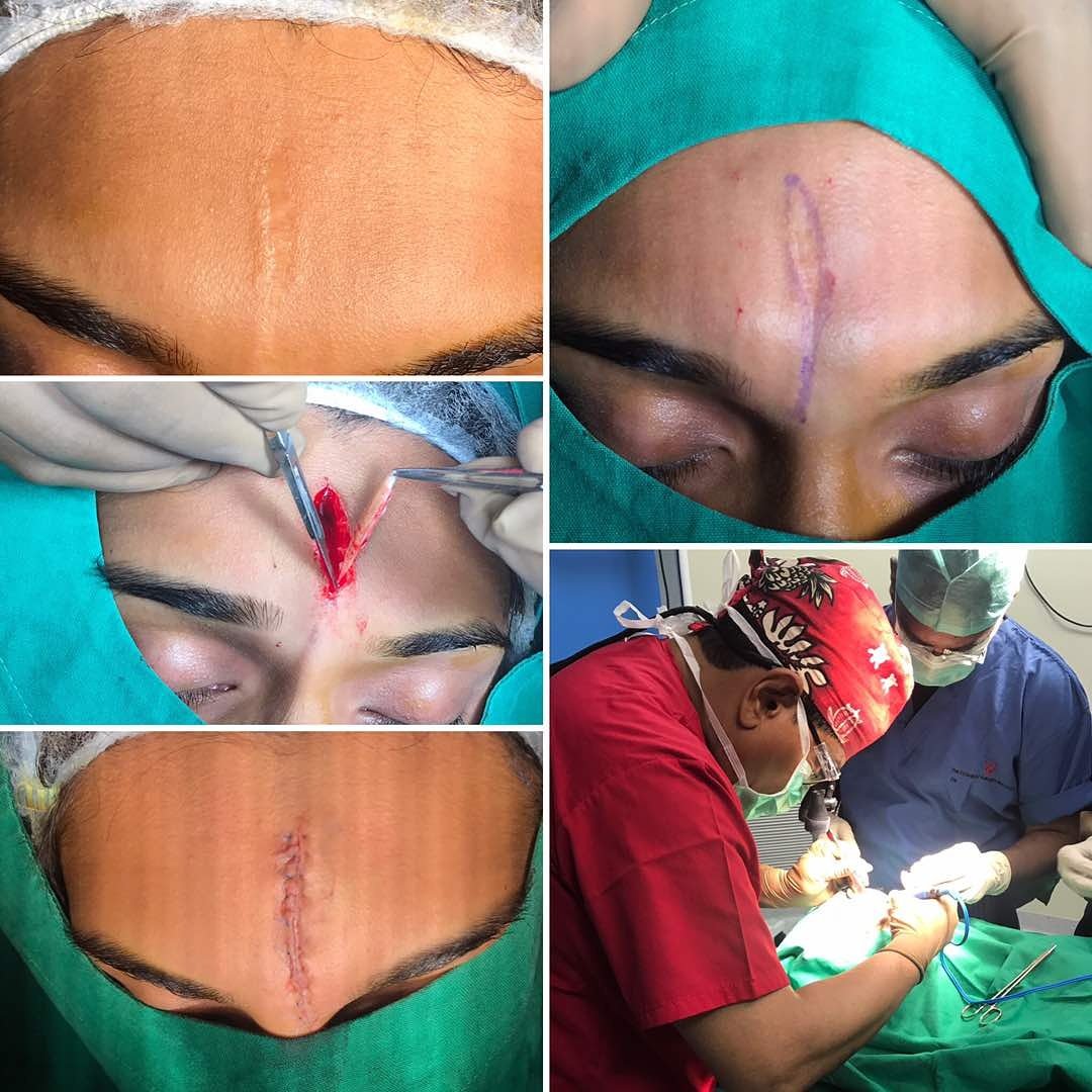 SCAR REVISION 
# CosmrticSurgeryInstitute 
The Benchmark 
Mumbai India 
CSISITE.COM 
drmohanthomas@gmail .com