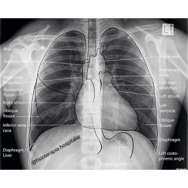 FisioterapiaHo's tweet photo. #physiotherapy  #torax  #fisioterapia   #tórax  #enfermagem   #fisiogata #radiología  #radiologia #corpohumano #uti #raioxdigital https://t.co/BT8UIHtXcr