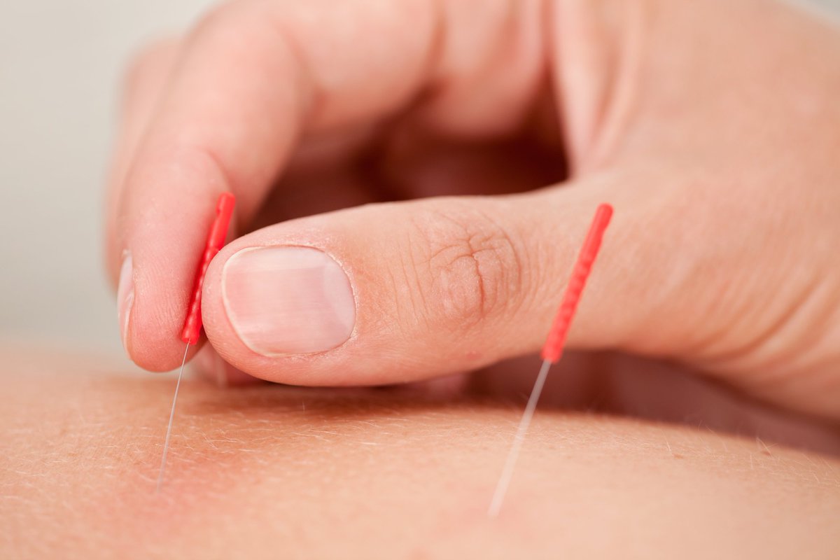 DiscoverPulse's tweet image. What do you like about getting acupuncture treatment done? Share with us in the comments below!