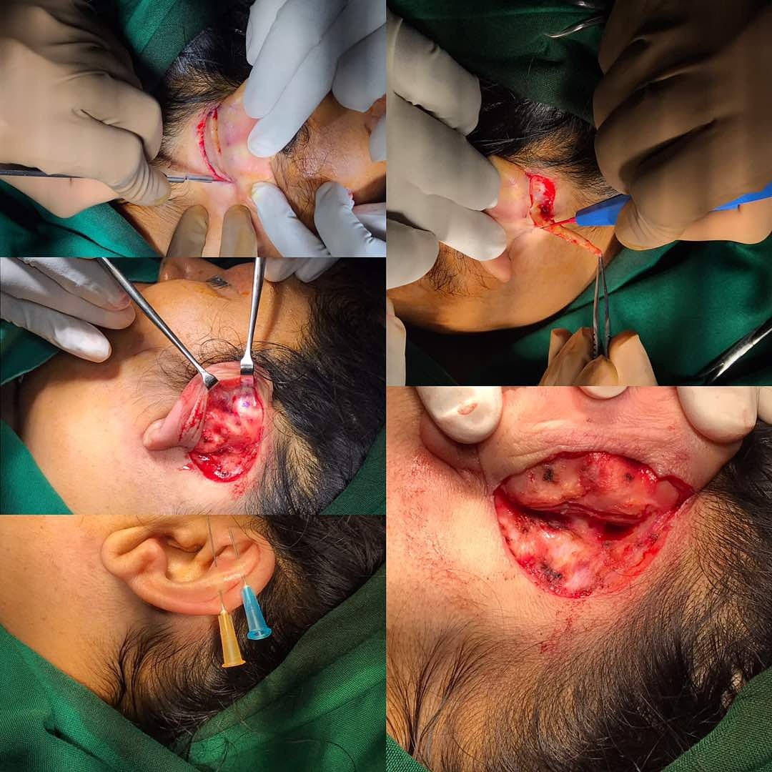 OTOPLASTY (Ear Correction) 
#CosmeticSurgeryInstitute 
The Benchmark
MUMBAI INDIA 
csisite.com
drmohanthomas@gmail