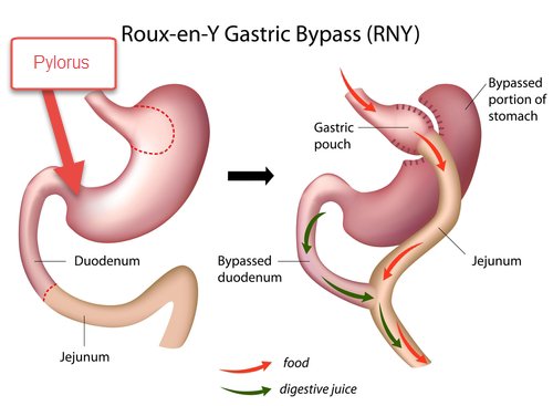Dating After Bariatric Surgery Things Change