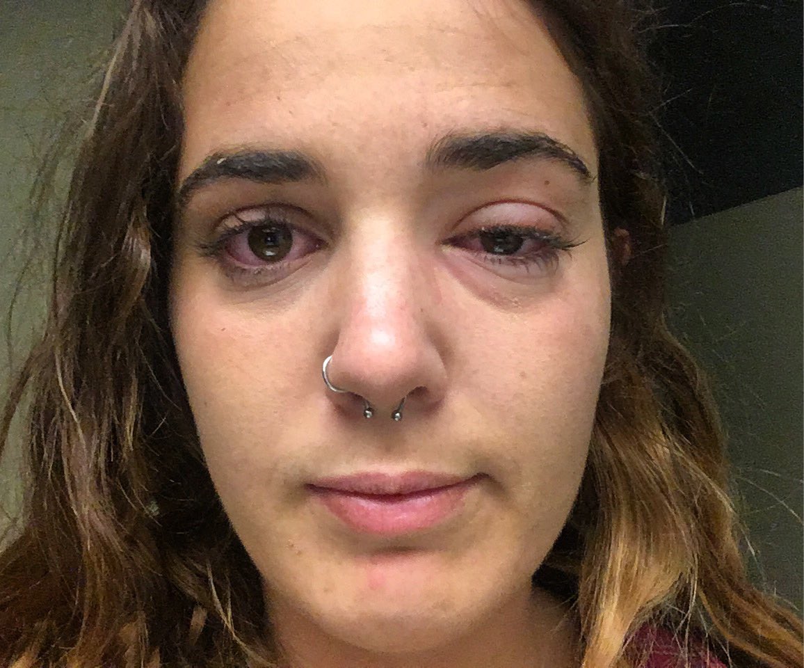 agrund12's tweet photo. Justin Bieber has conjunctivitis you can see it in these 4 photos https://t.co/PZSuKLVhv0