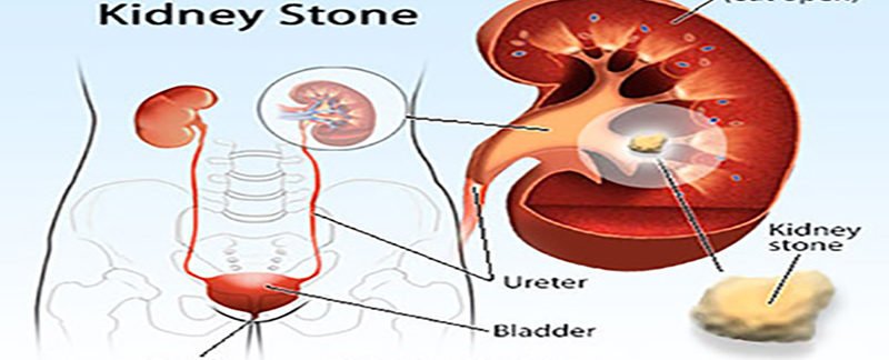 Mariajee's tweet image. Kidney Stones Treatment - Home Remedies For Kidney Stones Symptoms - infocentre.co/kidney-stones-…