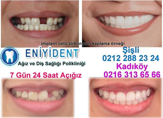 Şişli İmplant Diş Konusunda En İyisi ... ve #IstanbulşişliImplantDiş #şişliImplantDiş tüm bilgiler için tıklayınız uzmandisdoktoru.net/sisli-implant-…