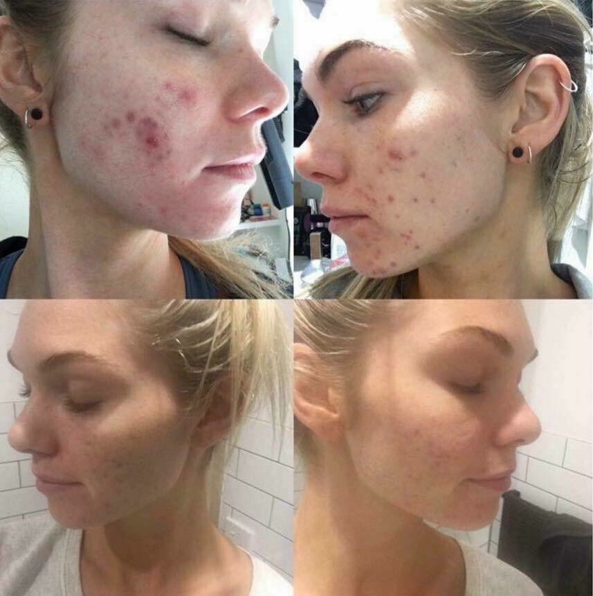 leandra_goodall's tweet photo. 😱😱 Lexi's skin results are just #SIX weeks on our Berry Capsules 🙌🏽🍇 

Literally love these little magic beans 😍🙏🏽👏🏽
#LYB https://t.co/c5lBqVDzAT