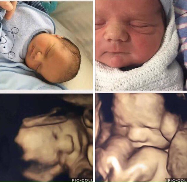 Thus is Beautiful Baby Arlo! His wonderful mummy kindly sent us these comparison photos today and we think they are truly amazing! 💙🍼🐻