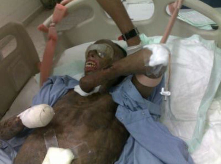 Abdulmane's tweet photo. نايف والله يحتاج وقفة صادقة من الجميع
نايف والله يعاني معاناة شديدة
سافرت معه إلى الهند
رأيت بعيني المعاناة الحقيقية
 #علاج_نايف_جازي_الحربي https://t.co/dg7yRMlge5