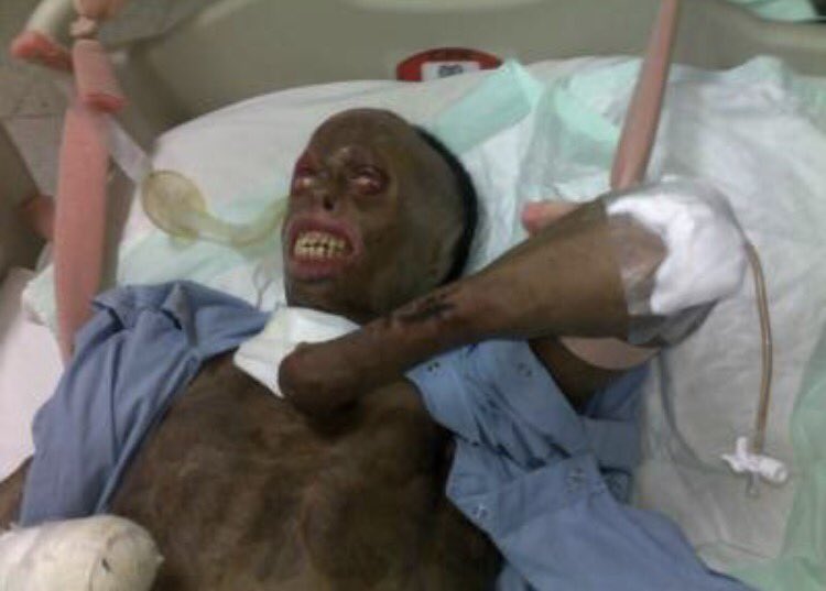 Abdulmane's tweet photo. نايف والله يحتاج وقفة صادقة من الجميع
نايف والله يعاني معاناة شديدة
سافرت معه إلى الهند
رأيت بعيني المعاناة الحقيقية
 #علاج_نايف_جازي_الحربي https://t.co/dg7yRMlge5
