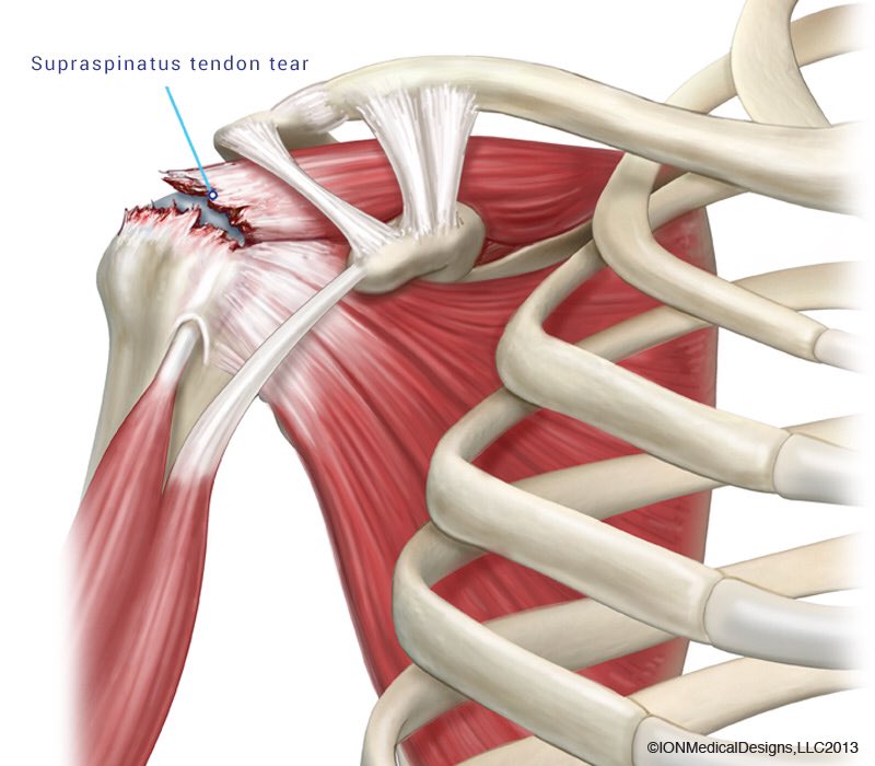 TannerLooksLike's tweet photo. A torn rotator cuff #ThingsTannerLooksLike https://t.co/m2UcNu0aJB