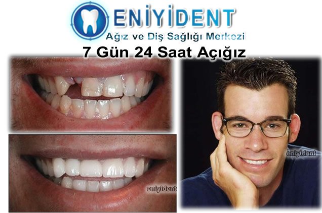 Çocuklar da Ortodonti ... ve #OrtodontiTedavisiFiyatları2017 #OrtodontiTedavisiNedir tüm bilgiler için tıklayınız uzmandisdoktoru.net/cocuklar-da-or…