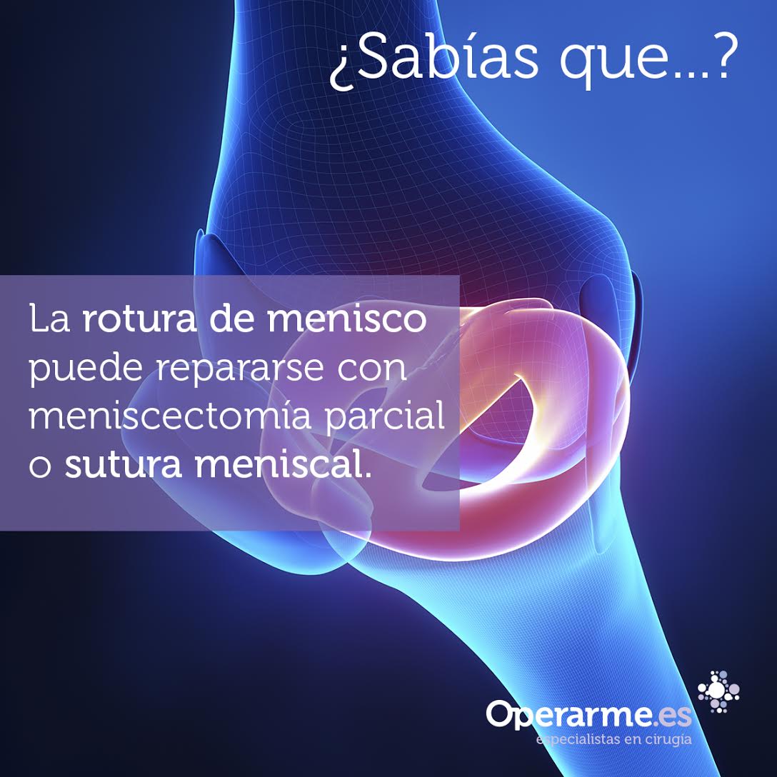 Operarme's tweet photo. #RoturaDeMenisco #Menisectomía #SuturaMeniscal #EspecialistasCirugía https://t.co/tNyY9EmtTJ