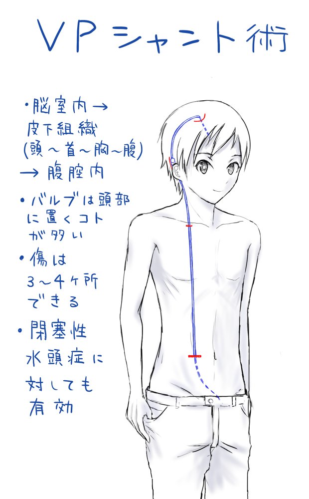 ブログのVPシャント術の解説図を描き直して追加しました(https://t.co/ApEe0kLZ4z)。
よくあるマネキン風の解説図から脱却したくて頑張りましたがいろいろと限界でした。 