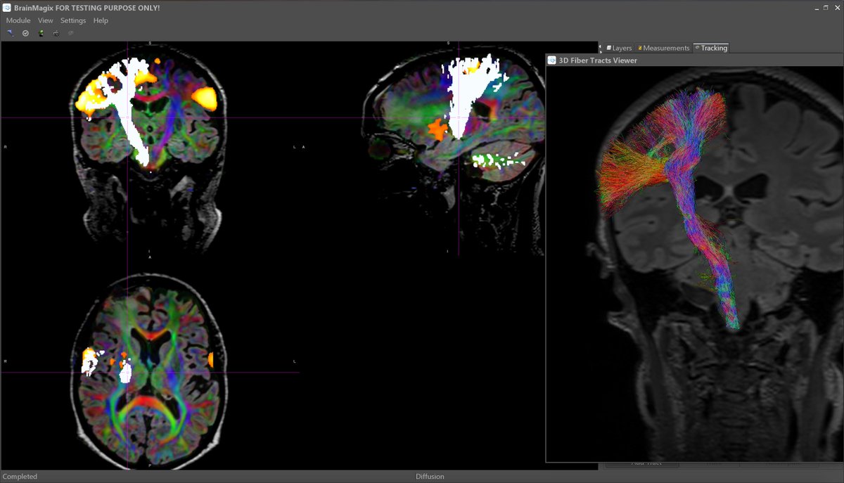 Imagilys's tweet photo. Motor fMRI and CSD-based tractography in a patient with an oligodendroglioma in the right frontal lobe. In #BrainMagix by @VslsKatsaros https://t.co/Hz9E00yhBf