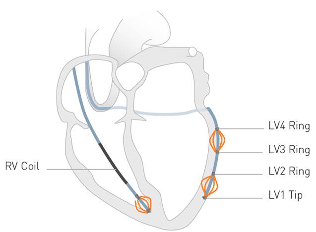 Biotronik_UK's tweet photo. "Multipolar leads are likely to be the way forward" Intica HFT has #multipole pacing! #CareBeyond #360Care https://t.co/QPYRwcjy0w #CRT https://t.co/ACDxo3jEkw