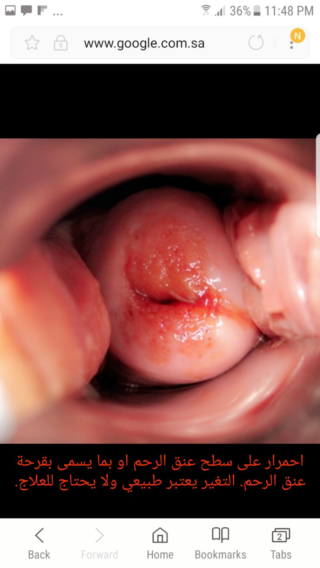 Dr. Picasso د. حازم المنديل on X: صورة لقرحة عنق الرحم وهي احمرار وتعتبر  شكل طبيعيه وقد تحتاج لعمل مسحة عنق الرحم. لا تحتاج لعلاج او كي كما يتم  الترويج له في