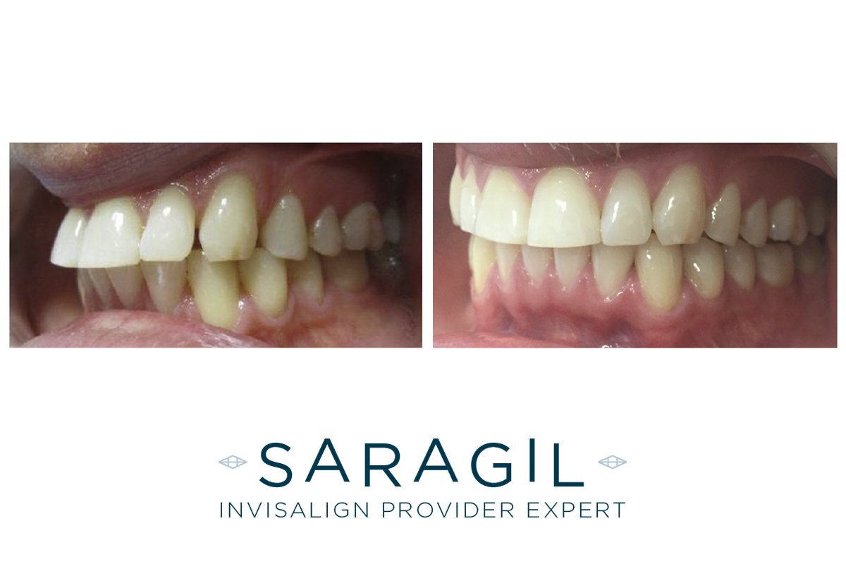 DoctoraSaraGil's tweet photo. Benjamin vino con dientes adelantados y diastemas, tras el tratamiento de #InvisalignLite el resultado ha sido de #sonrisa perfecta. 😃🙌 https://t.co/PfLL3Qlf6M