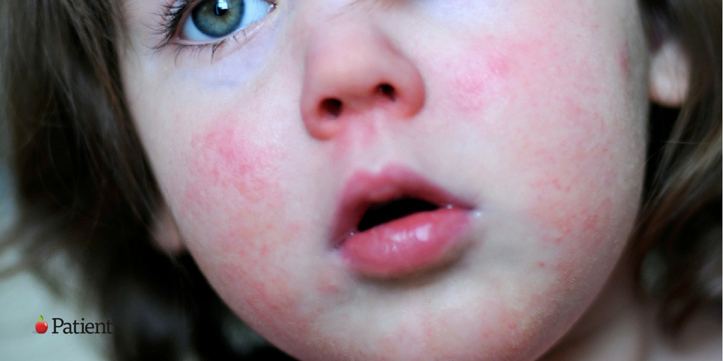 How to Treat Scarlet Fever Quickly: buff.ly/2qGexFP