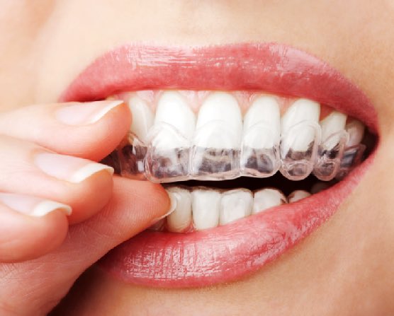 fitcareproducts's tweet image. Need a clear retainer? Use this promo code PAQKIY at Clearretain.com to get 5% off. #smile #teeth #orthodontist #dentist #health