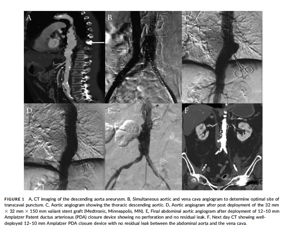 ZaherFanari's tweet image. Percutaneous thoracic aortic aneurysm repair through
transcaval aortic access.
onlinelibrary.wiley.com/doi/10.1002/cc…
@SCAI #ACCIC #TEVAR #Transcaval