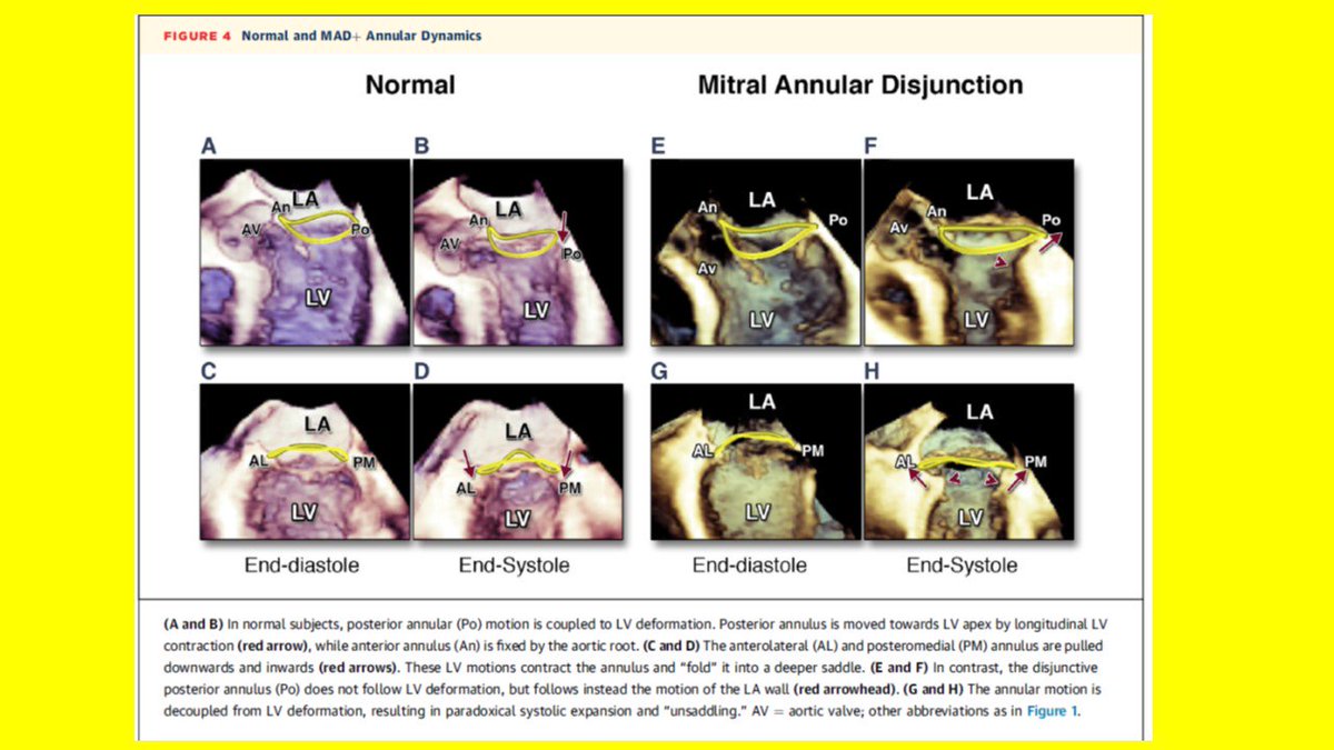 echocardiac's tweet photo. DYSJUNCTION IN MITRAL VALVE PROLAPSE
by the American College of Cardiology Foundation
#echocardiography #MVP #SCD #echocardiac https://t.co/ncSFg9hnuI
