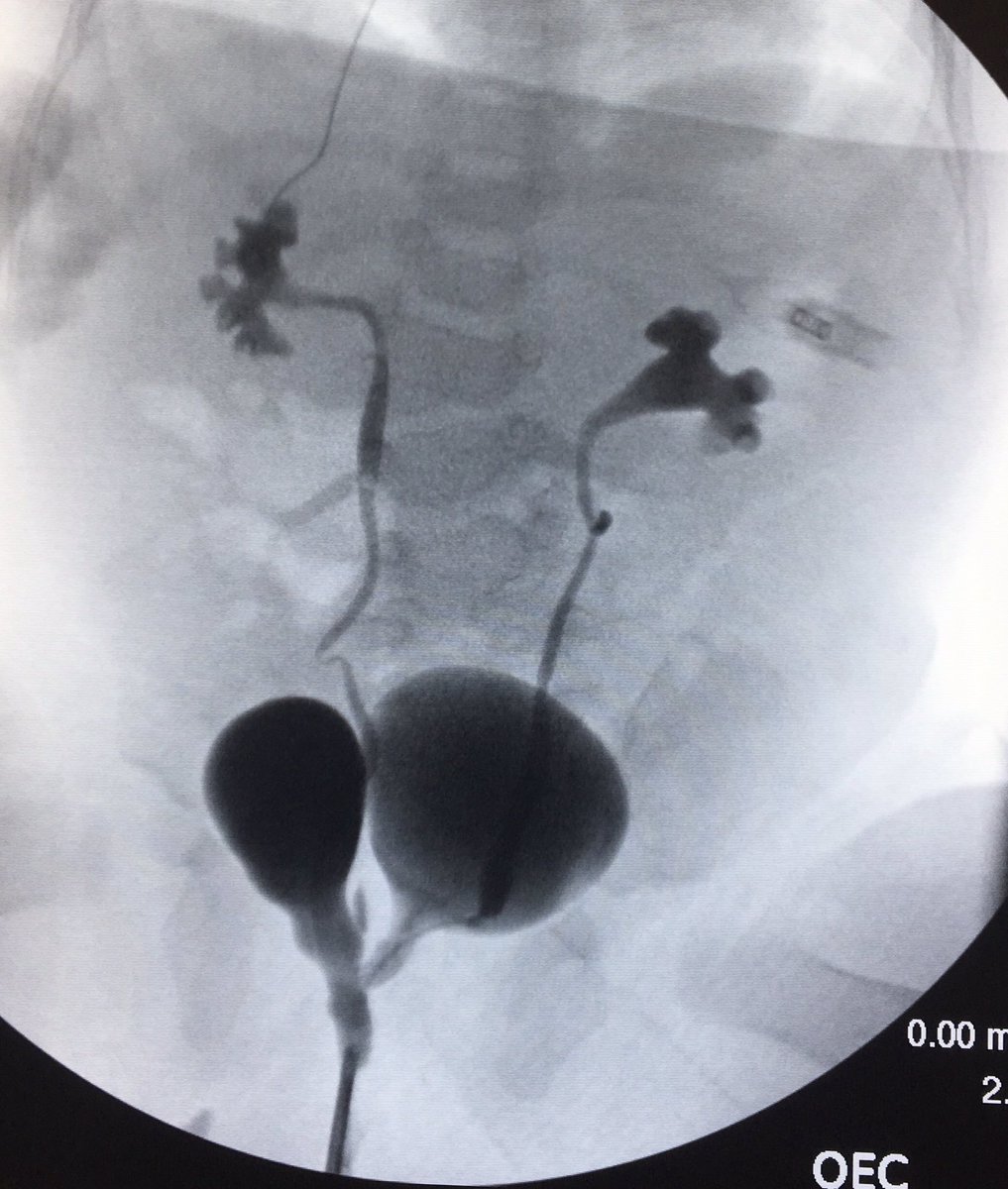 Hmmm. What to do? Two bladders, single ureter to each, 2 bladder necks and one distal urethra <a href="/AmerUrological/">Amer. Urol. Assn.</a> <a href="/SPU_Urology/">SPU_Urology</a>