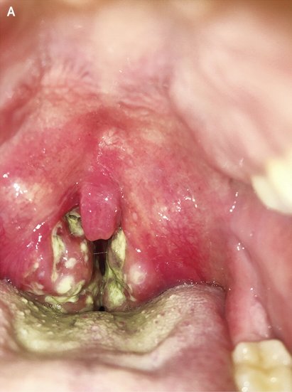 Allergic reaction throat sore