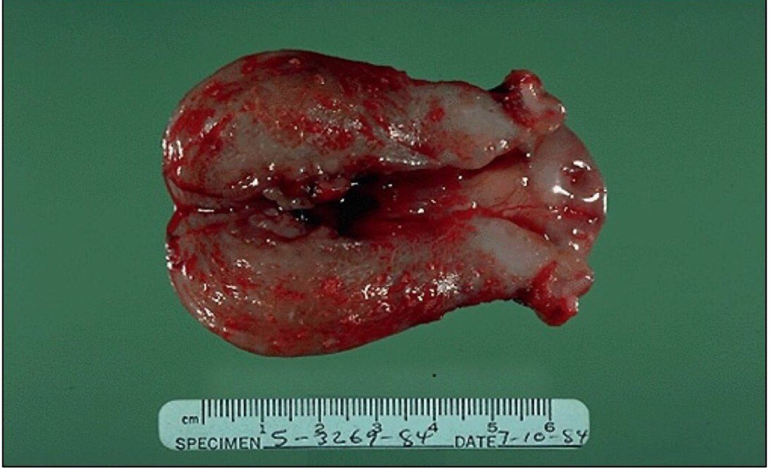 pathology_435's tweet photo. Endometrial Adenocarcinoma:
Haemorrhagic mass at the uterine fundus.
#med435 https://t.co/JrhWgoxruP