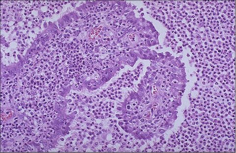 pathology_435's tweet photo. 1.Edematous and swollen fallopian tube mucosa.
2.Infiltration by numerous neutrophils. https://t.co/TLQkMk058D