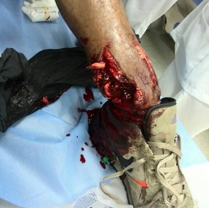 Gato_Vzla's tweet photo. Por defender la libertad, un francotirador desde la azotea en PDVSA #LaBoyera #Caracas le voló la pierna a este muchacho
.@DolarToday https://t.co/V1eVXker5s