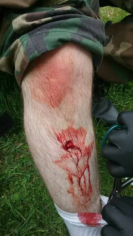 Fox_Fire_Films's tweet photo. I took a bad leg injury just Sunday playing at Keeper's field with the NEPA Wolf Pack and the Weekend Warriors. Five stitches closed me up. https://t.co/29MsYgrGI6