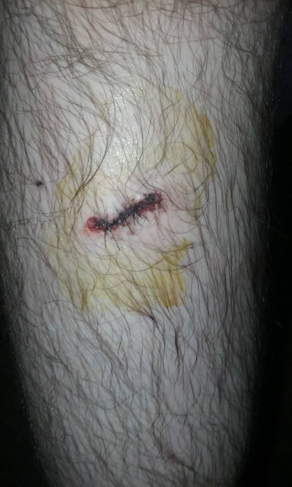 Fox_Fire_Films's tweet photo. I took a bad leg injury just Sunday playing at Keeper's field with the NEPA Wolf Pack and the Weekend Warriors. Five stitches closed me up. https://t.co/29MsYgrGI6