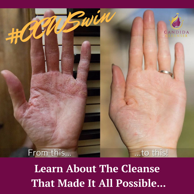 CandidaCleanser's tweet photo. When the #candidadiet & #GAPSdiet didn't work she added the Candida Cleanser & healed chronic #eczema #ccwswin https://t.co/QZhsvjGfEw https://t.co/2L0jMYTk54