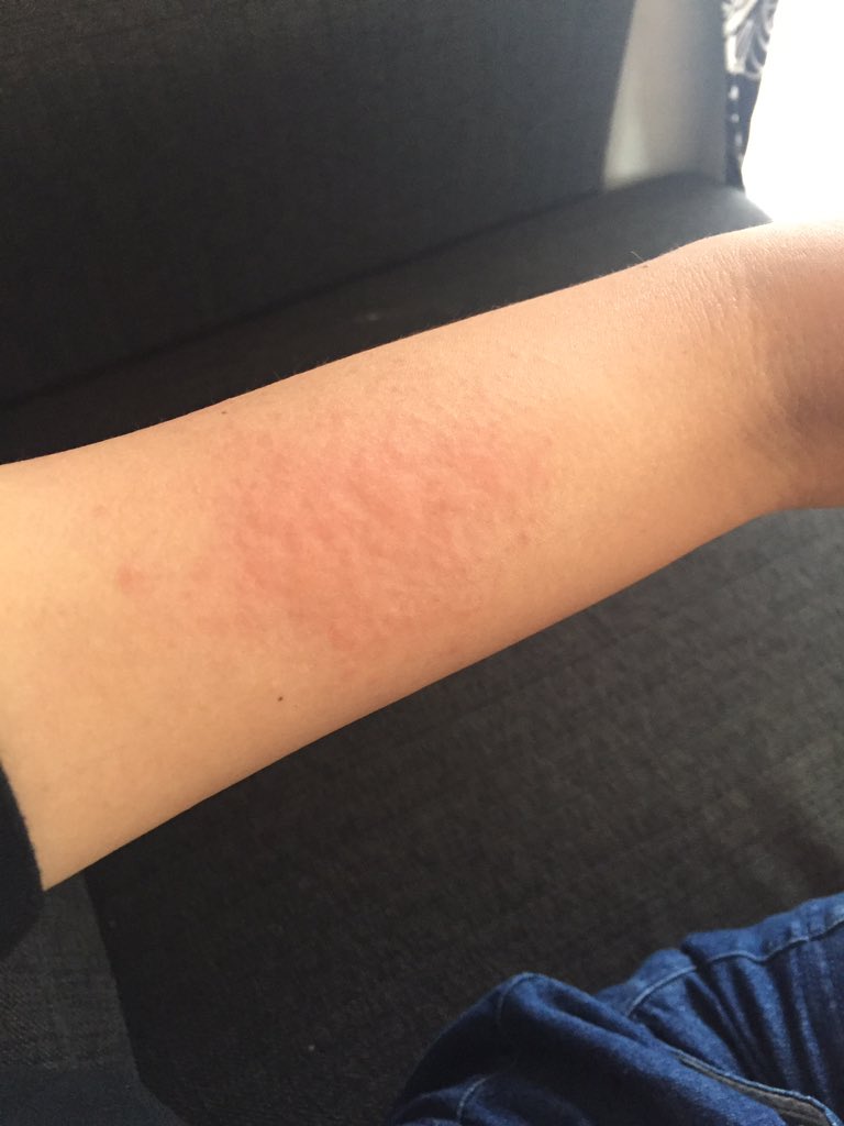 てらぴーうんぴーゆんこぴー Sur Twitter 日焼け止めしないと もう若くないね 蕁麻疹