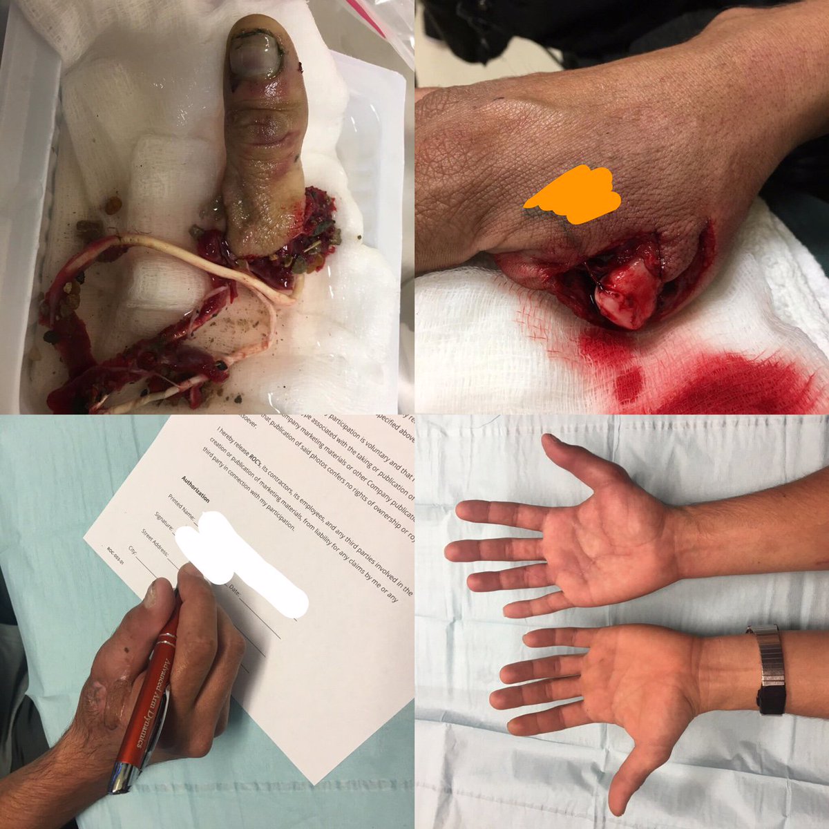 rocofhouston's tweet photo. Our blog is updated. Check out a thumb reattachment article. https://t.co/TXWwIf0WOf #rocofhouston #fernandolevaro #yevgenyshuhatovich https://t.co/CkCHvNRk9w